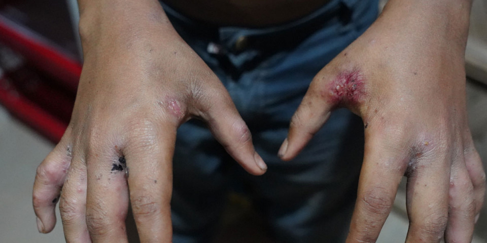 一名幼童在無國界醫生位於孟加拉科克斯巴扎爾(Cox's Bazar)的哈欽帕拉(Hakimpara)診所接受疥瘡治療 ©Maliha Tabassum/MSF