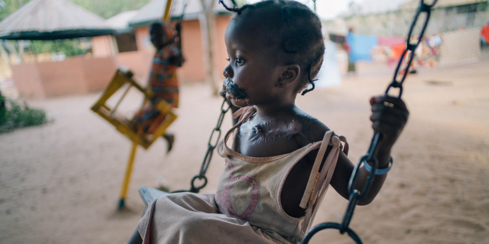 感染壞疽性口炎而倖存的四歲小女孩，攝於2016年。©Claire Jeantet - Fabrice Caterini/INEDIZ