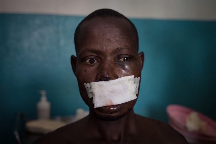 33歲的甘比是一位農夫。武裝分子在一次試圖偷取他的牛隻時射傷了他的左臉頰及嘴巴。©Alexis Huguet